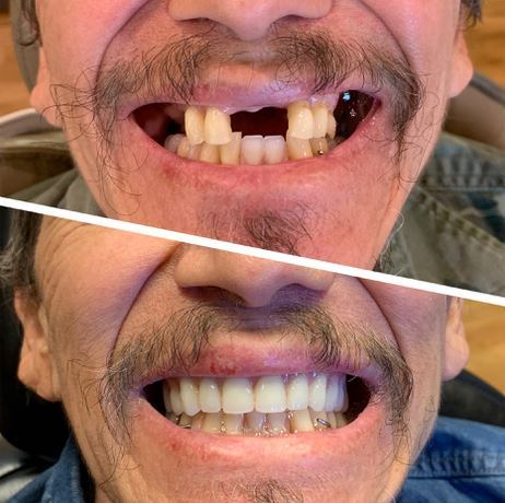 teeth before and after