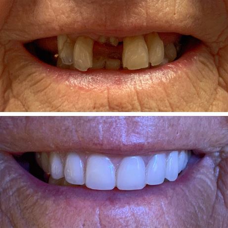 teeth before and after