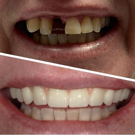 before and after teeth