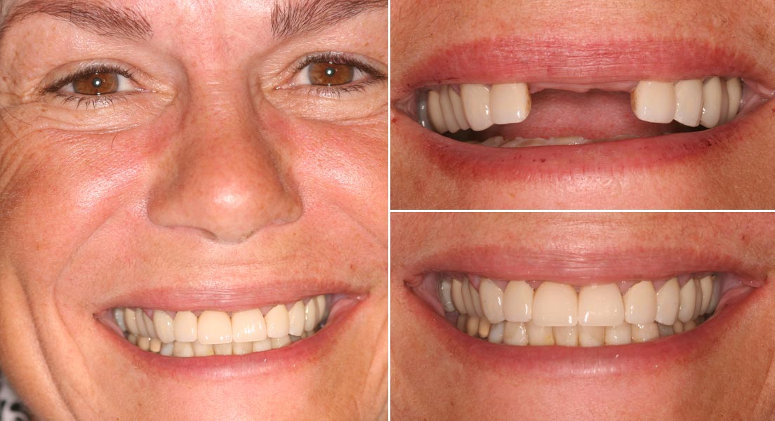 Veneers in Silver City, New Mexico Sherman Dental